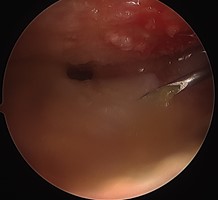 lesione cartilaginea